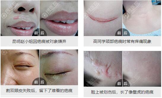 最新瘢痕治疗技术，步骤指南与治疗方法解析