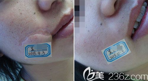 全新祛疤科技产品重塑肌肤完美重塑，颠覆传统祛疤价格体验！