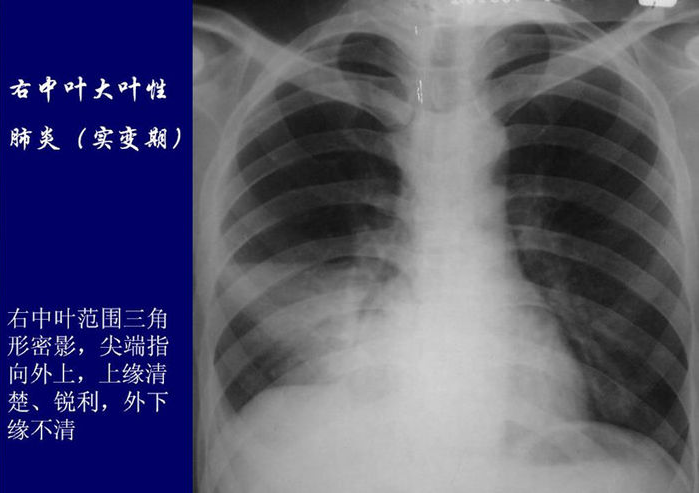 最新肺炎分布观点论述，探讨肺炎的分布现状与趋势分析